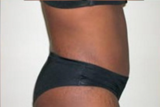 Abdominoplasty Before & After Patient #894