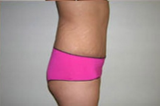 Abdominoplasty Before & After Patient #895