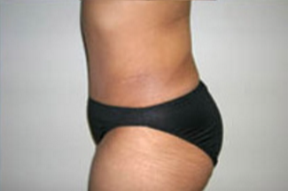 Abdominoplasty Before & After Patient #897