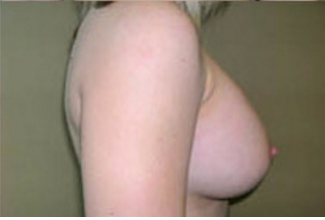 Breast Augmentation Before & After Patient #375