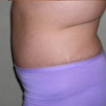 Abdominoplasty Before & After Patient #900