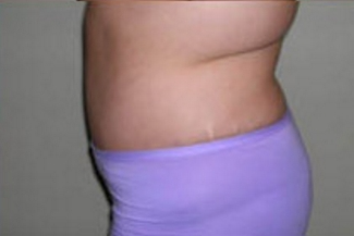 Abdominoplasty Before & After Patient #900