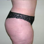 Abdominoplasty Before & After Patient #901