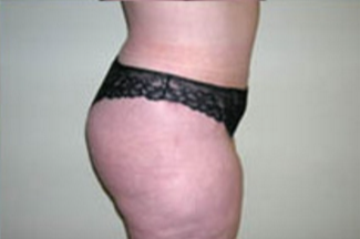 Abdominoplasty Before & After Patient #901