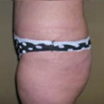 Abdominoplasty Before & After Patient #941