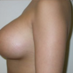 Breast Augmentation Before & After Patient #376