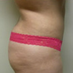 Liposuction Before & After Patient #1025