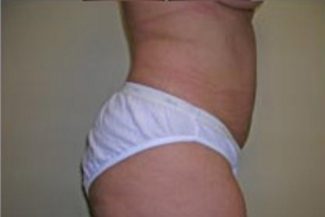 Liposuction Before & After Patient #1058