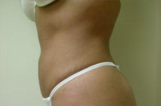 Liposuction Before & After Patient #1063