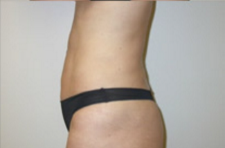 Liposuction Before & After Patient #1094