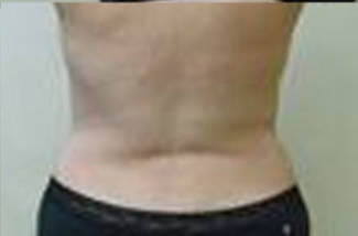 Abdominoplasty Before & After Patient #946