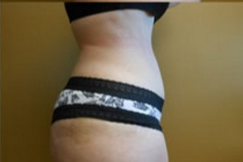 Abdominoplasty Before & After Patient #780